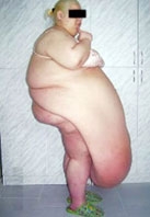 Cắt bỏ bụng mỡ 57 kg