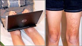 Vì sao không nên đặt laptop trên đùi?