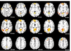 Tranh cãi xung quanh việc sử dụng hình ảnh MRI trong xử án