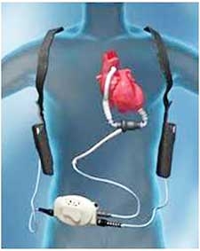 Hy vọng sống cho những 
bệnh nhân suy tim nặng