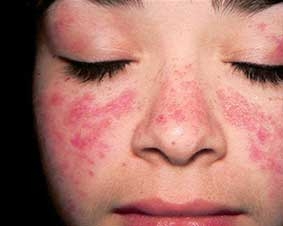 10 căn bệnh có thể đi kèm theo lupus ban đỏ
