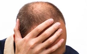 Chữa hói đầu nhờ 
phương pháp “ma cà rồng”