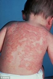Thuốc kháng sinh và nguy cơ mắc chàm bội nhiễm ở trẻ nhỏ