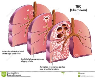 Tế bào gốc tủy xương có thể diệt vi khuẩn lao đa kháng thuốc