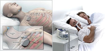 Thiết bị cấy dưới da chống ngừng thở khi ngủ