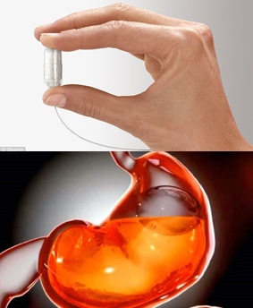Đặt bóng dạ dày chữa béo phì không cần phẫu thuật