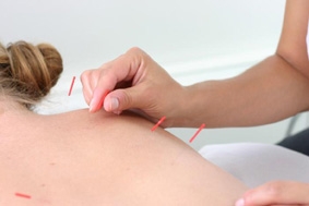 Châm cứu giảm triệu chứng “bốc hỏa” ở phụ nữ mãn kinh