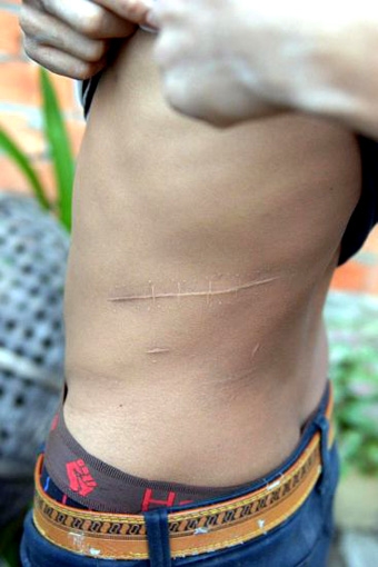 Bán thận nuôi thân