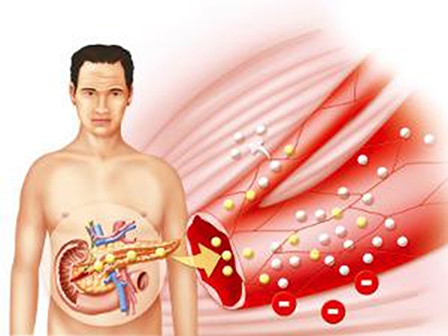Giảm cân giúp đảo ngược tiến triển 
của bệnh tiểu đường típ 2