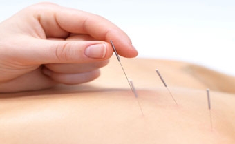 Châm cứu làm giảm triệu chứng đau cơ xơ hóa