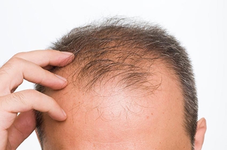 Phương pháp mới điều trị hói đầu