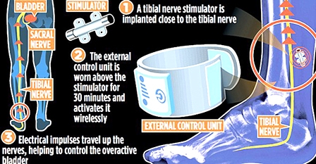 Vòng đeo chân hỗ trợ 

bệnh nhân OAB