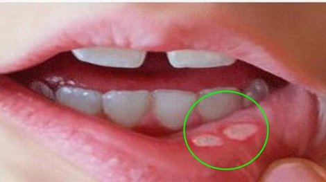 Những dấu hiệu đặc trưng cảnh báo cơ thể thiếu kẽm