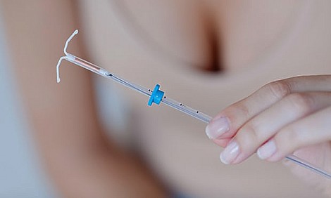 Vòng tránh thai giảm 30% nguy cơ ung thư cổ tử cung