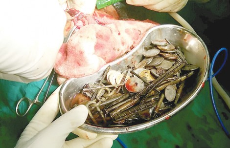Nuốt 263 đồng xu

và 100 cây đinh