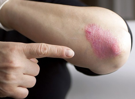 Chiết xuất va-ni có thể phòng trị vẩy nến