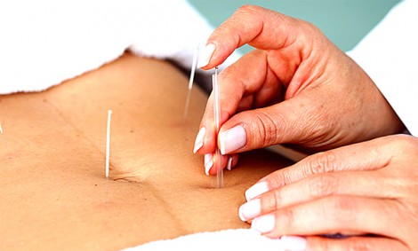Châm cứu giúp giảm cân hiệu quả