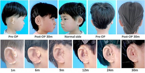 Tái tạo vành tai sinh học cho trẻ

bị khiếm khuyết bẩm sinh