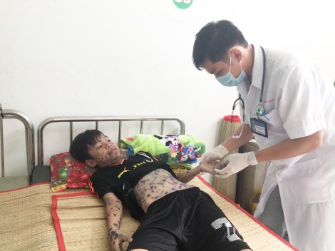 Cảnh báo bệnh thủy đậu