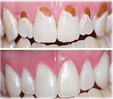 Kỹ thuật mới tái tạo men răng và xương
