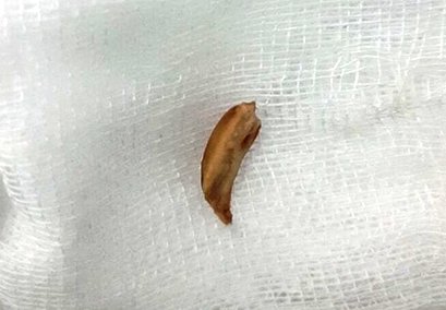 Suýt nguy tính mạng do hóc hạt sen