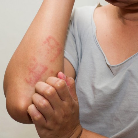 Lợi khuẩn trên da có thể điều trị chàm bội nhiễm