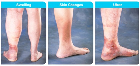 Những triệu chứng cảnh báo cơ thể bị tụ huyết khối