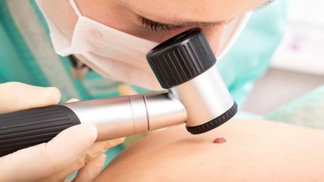 Tiềm năng gel bôi trị ung thư da