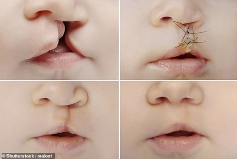Triển vọng chữa hở hàm ếch từ máu dây rốn