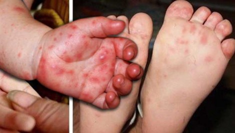 Ca tử vong đầu tiên do bệnh tay chân miệng ở Tiền Giang