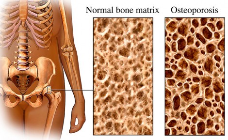 Xác định gien liên quan đến loãng xương