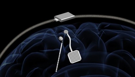 Triển vọng trong điều trị bệnh Parkinson và động kinh