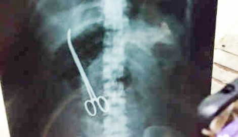 Bỏ quên chiếc kẹp

trong bụng bệnh nhân