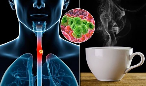 Uống trà quá nóng dễ mắc

ung thư thực quản