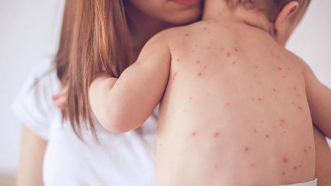 Mỹ cảnh báo bệnh sởi có thể hoành hành trở lại