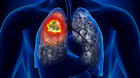 Xác định loại gien mở ra hy vọng cho bệnh nhân ung thư phổi