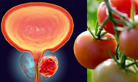 Lối sống tốt giúp phòng tránh ung thư tuyến tiền liệt