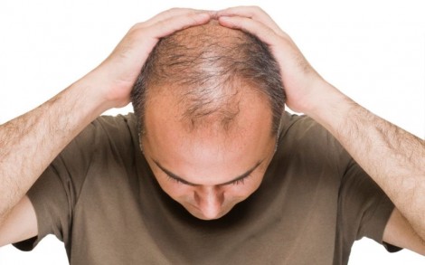 Ô nhiễm khói bụi làm tăng nguy cơ hói đầu