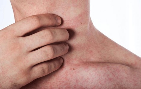 Nghiên cứu phương pháp chữa bệnh phát ban đỏ