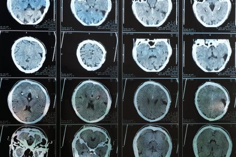 Bằng chứng béo phì có thể làm tăng nguy cơ mắc Alzheimer