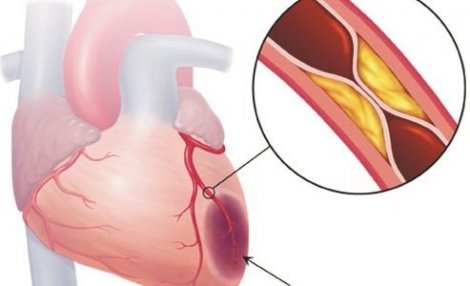 Bệnh viện Tim mạch TP Cần Thơ chụp và can thiệp mạch vành tỷ lệ thành công 100%