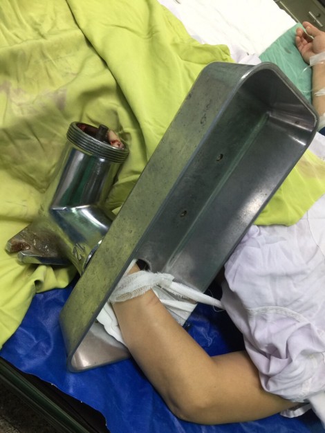 Máy xay thịt cuốn giập nát bàn tay trái
