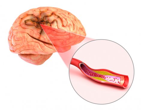 Đột quỵ não và vai trò của chụp cộng hưởng từ (MRI) trong tầm soát đột quỵ