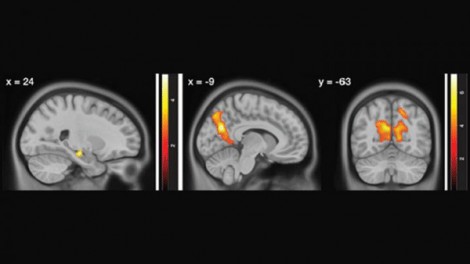 Hoạt động não quá mức có thể gây bệnh Alzheimer