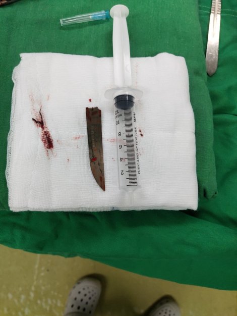 Cứu bệnh nhân bị dao đâm vào cột sống