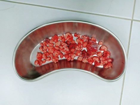 Lấy gần 100 viên sạn trong khớp háng nam thanh niên