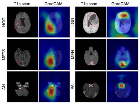 Chẩn đoán bằng AI - hy vọng mới trong cuộc chiến chống u não và Alzheimer