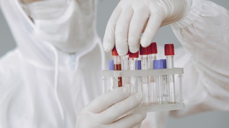 Xét nghiệm máu phát hiện sớm nguy cơ sa sút trí tuệ