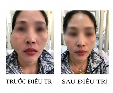 “Tiêm má baby” bằng filler, mặt bệnh nhân sưng to, bưng mủ