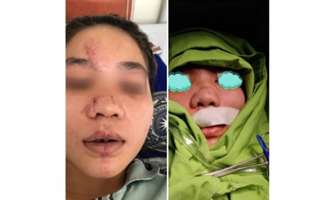 Chỉnh lại sóng mũi gãy cho cô gái trẻ bị tai nạn giao thông